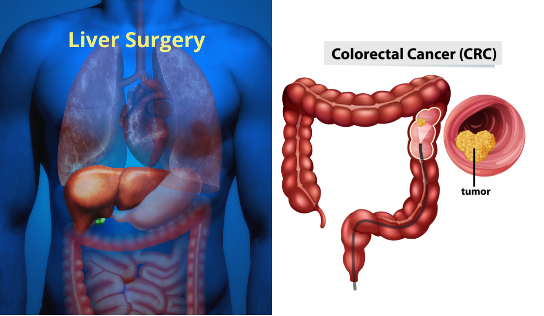 Colorectal Cancer: A Comprehensive GI Surgery Guide