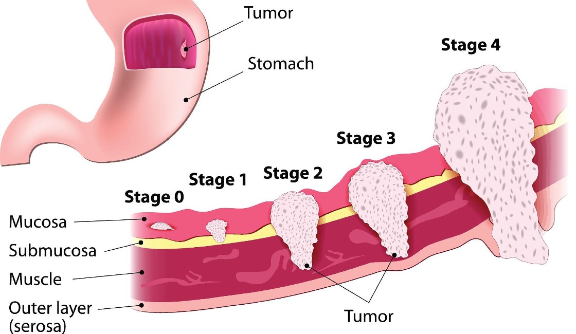 Comprehensive Guide to GI Surgery for the Stomach: Conditions, Procedures & Recovery