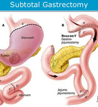 Gastrectomy