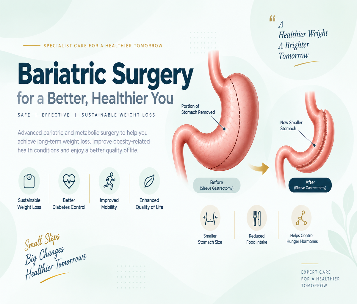 Bariatric surgery and sleeve gastrectomy medical illustration