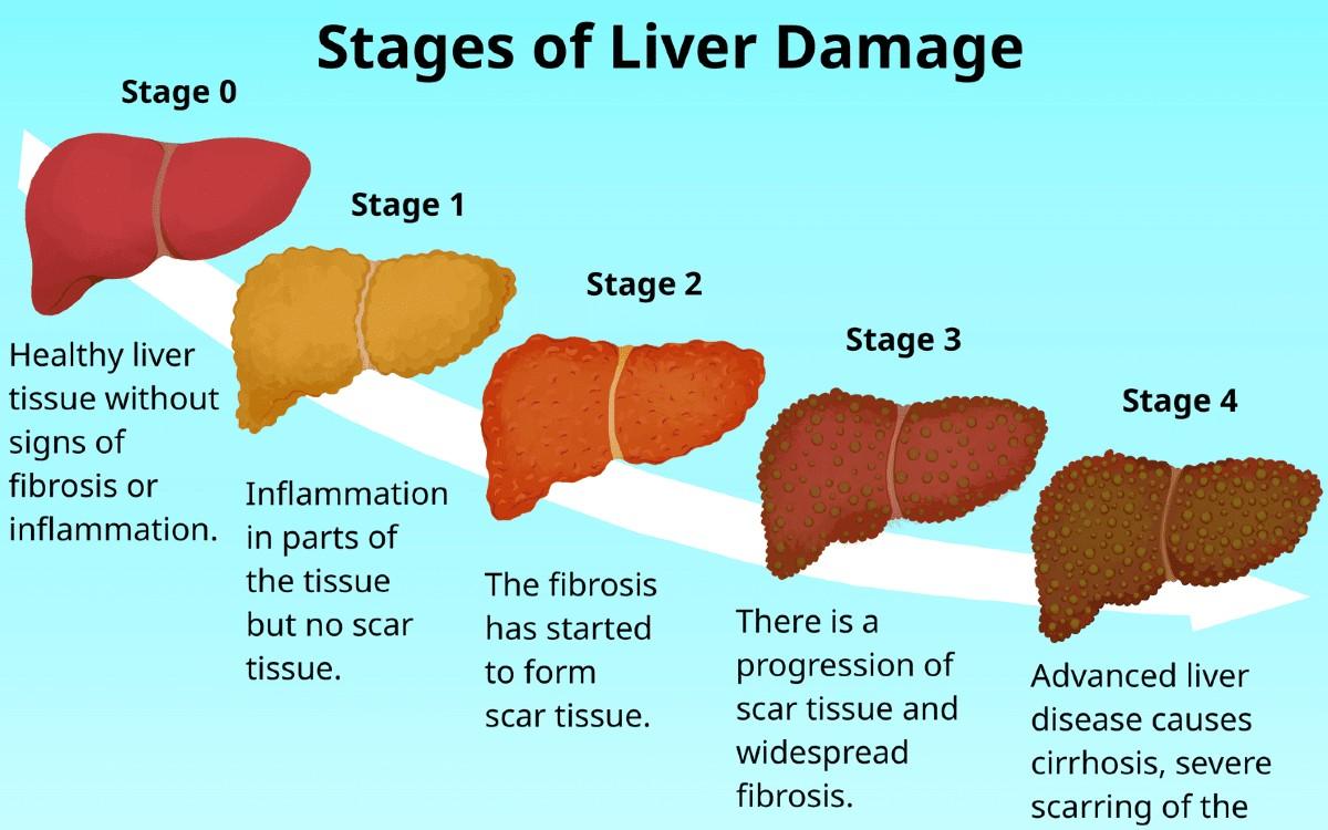 When Do You Need a Liver Transplant? Signs & Treatment Guide