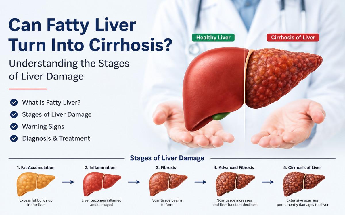 Can Fatty Liver Turn Into Cirrhosis? Understanding the Stages of Liver Damage