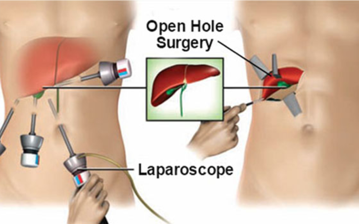 Don’t Ignore These Signs: You May Need Laparoscopic Surgery