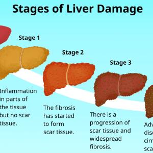 When Do You Need a Liver Transplant? Signs & Treatment Guide