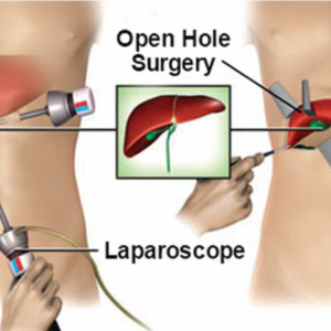 Don’t Ignore These Signs: You May Need Laparoscopic Surgery