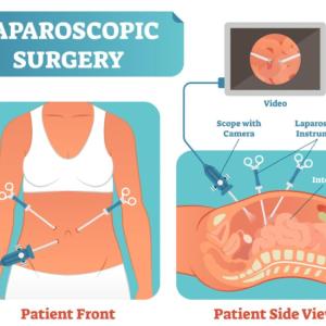 What to Expect Before and After Laparoscopic Surgery