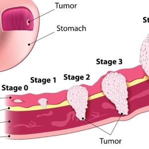 Stomach Gastrointestinal Surgery: When It’s Needed & What to Expect After Surgery